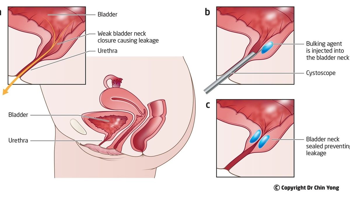 Urethral Bulking for Stress Urinary incontinence - Brazosport Women's Health