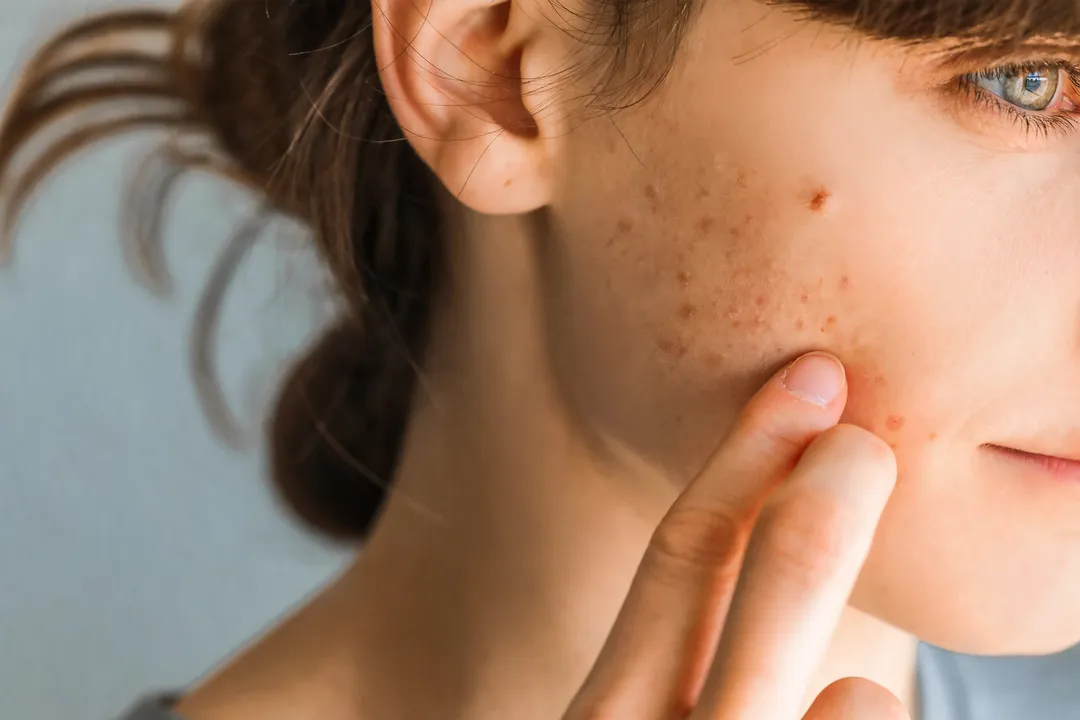 Teen+Girl+with+Hormonal+Acne