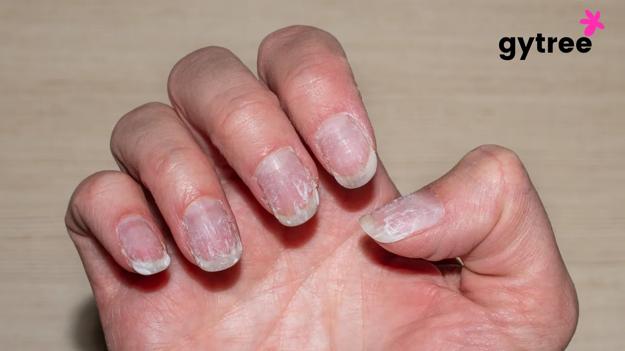 Constant chipping, peeling and brittle nails? Know how Biotin can help