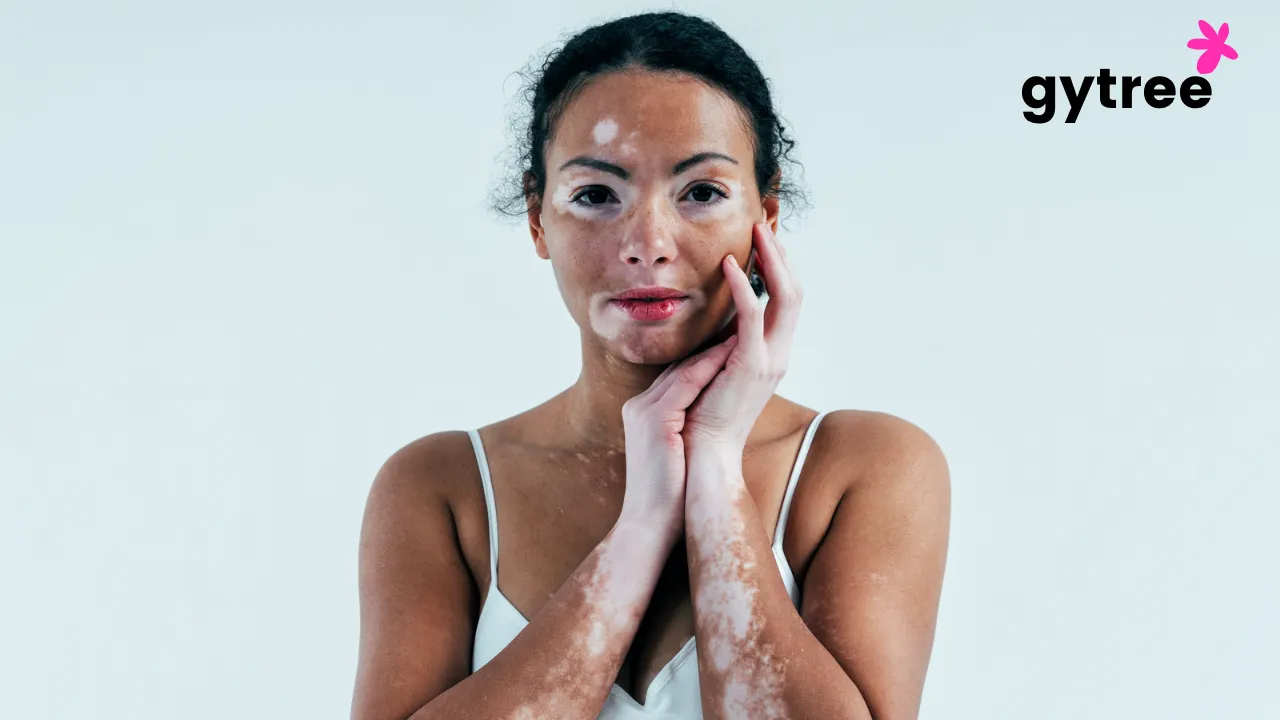 The Mosaic of the Skin- Why Vitiligo is More Than Skin Deep for Women?