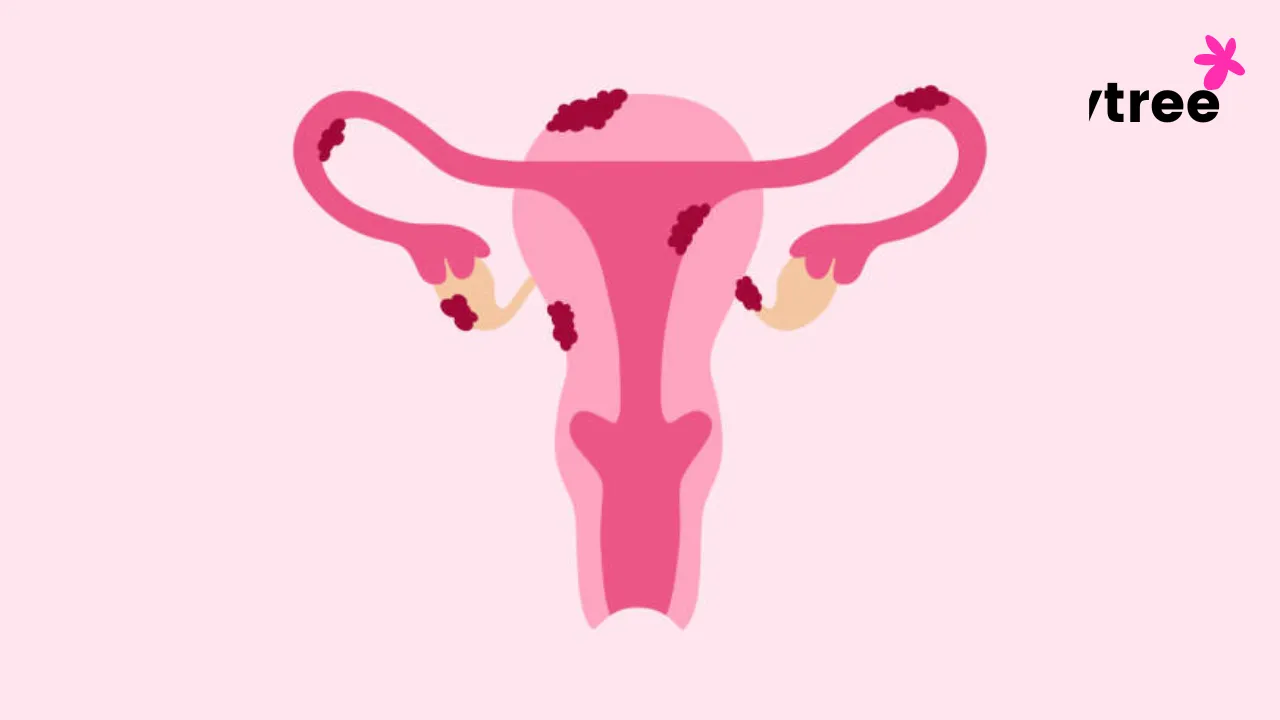 Understanding Ovarian Cysts: What Every Woman Should Know