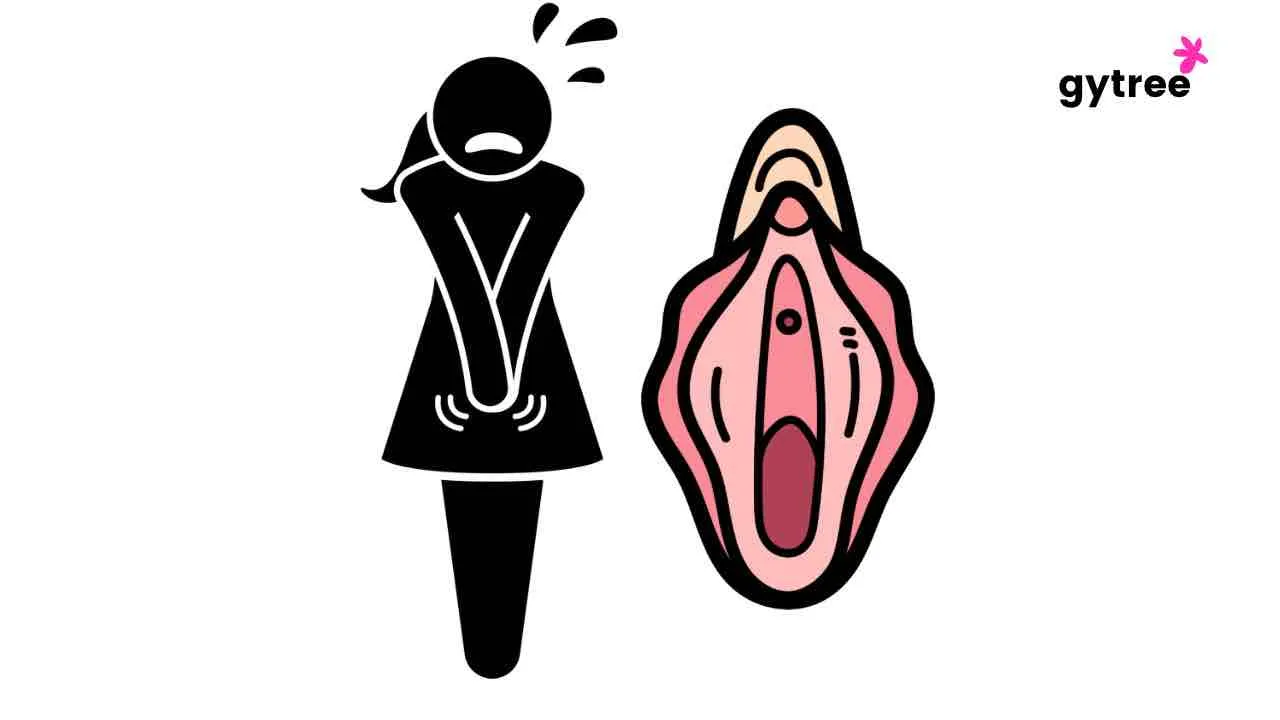 Vaginismus