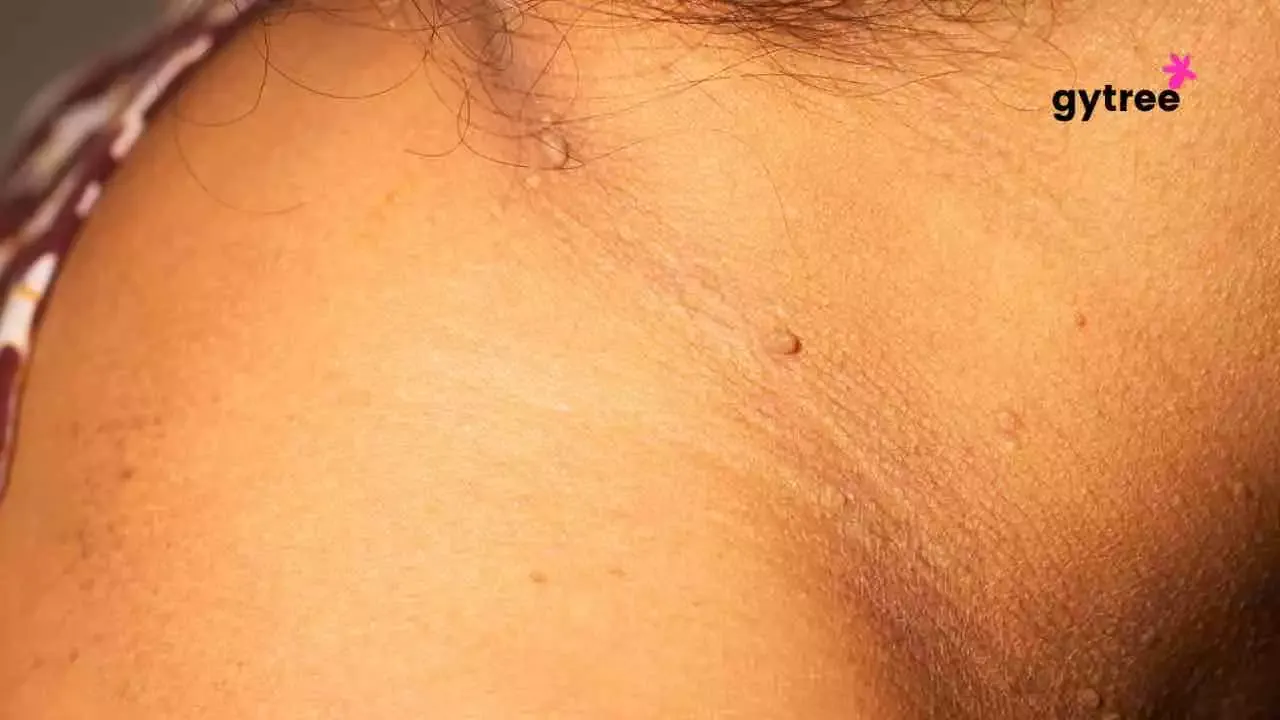 Dark neck: Know these main 6 causes