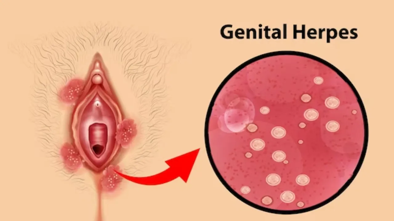 genital herpes
