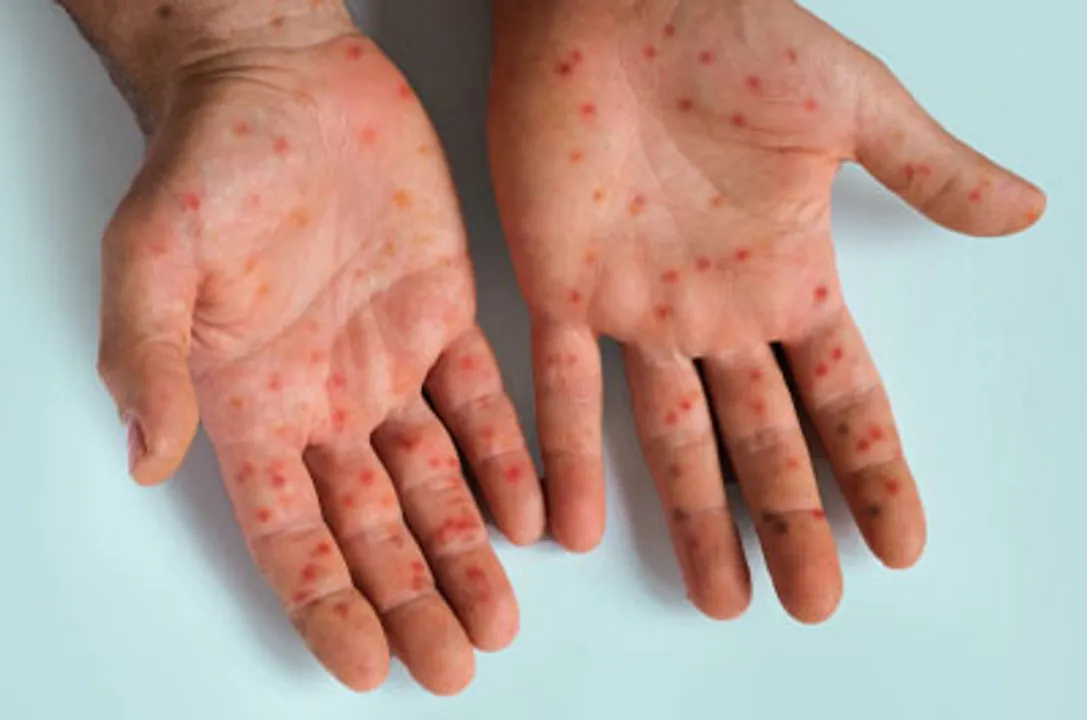 India to Update Mpox Guidelines Amid Global Health Emergency