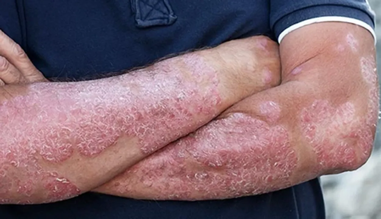  Combination immunotherapy may cure patients with deadly advanced skin cancer