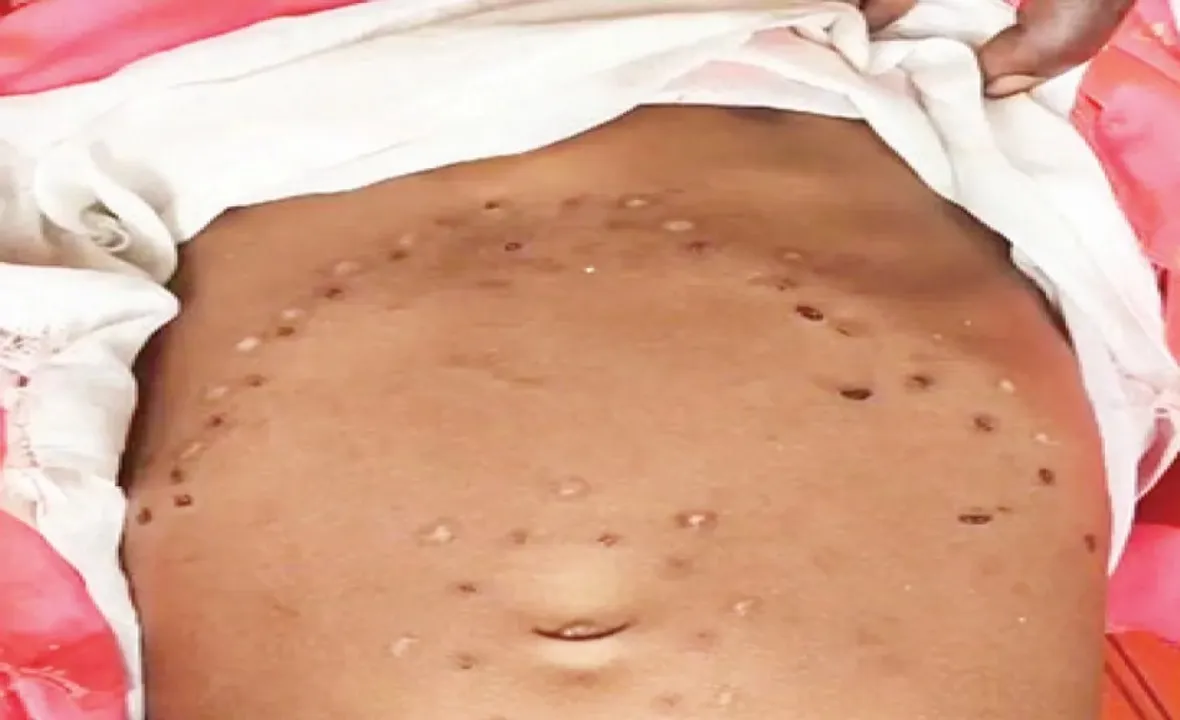  Odisha: Minor girl branded over 60 times with hot metal as 'cure' in Nabarangpur