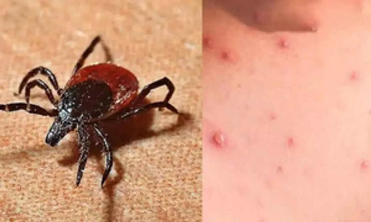  Rural communities at high risk of scrub typhus infections: Study