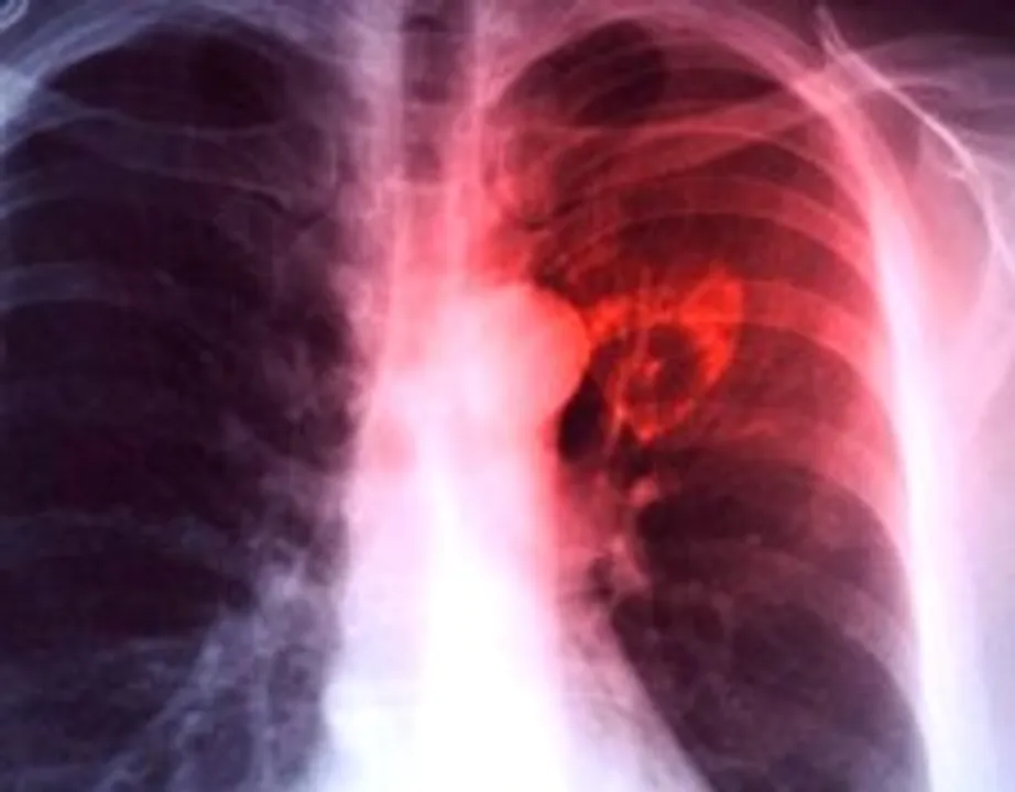  60% of vulnerable population for TB in 20 Odisha districts mapped