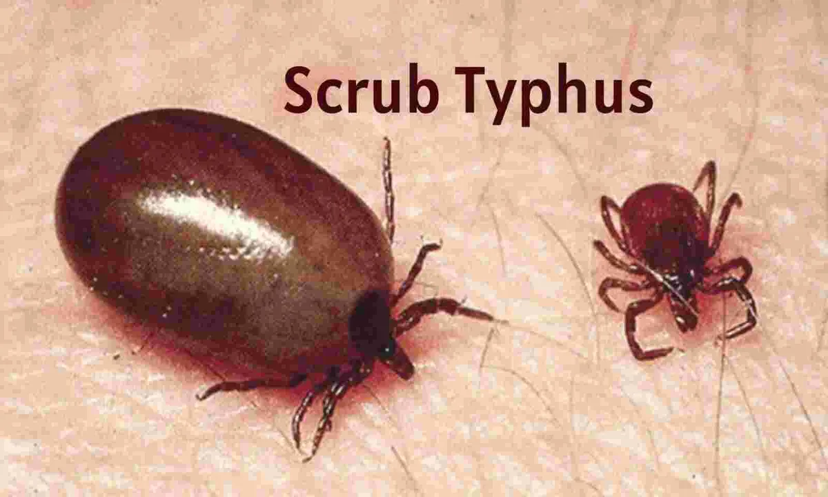  Scrub typhus cases on rise in Odisha’s Sundargarh; 11 new infections detected in single day