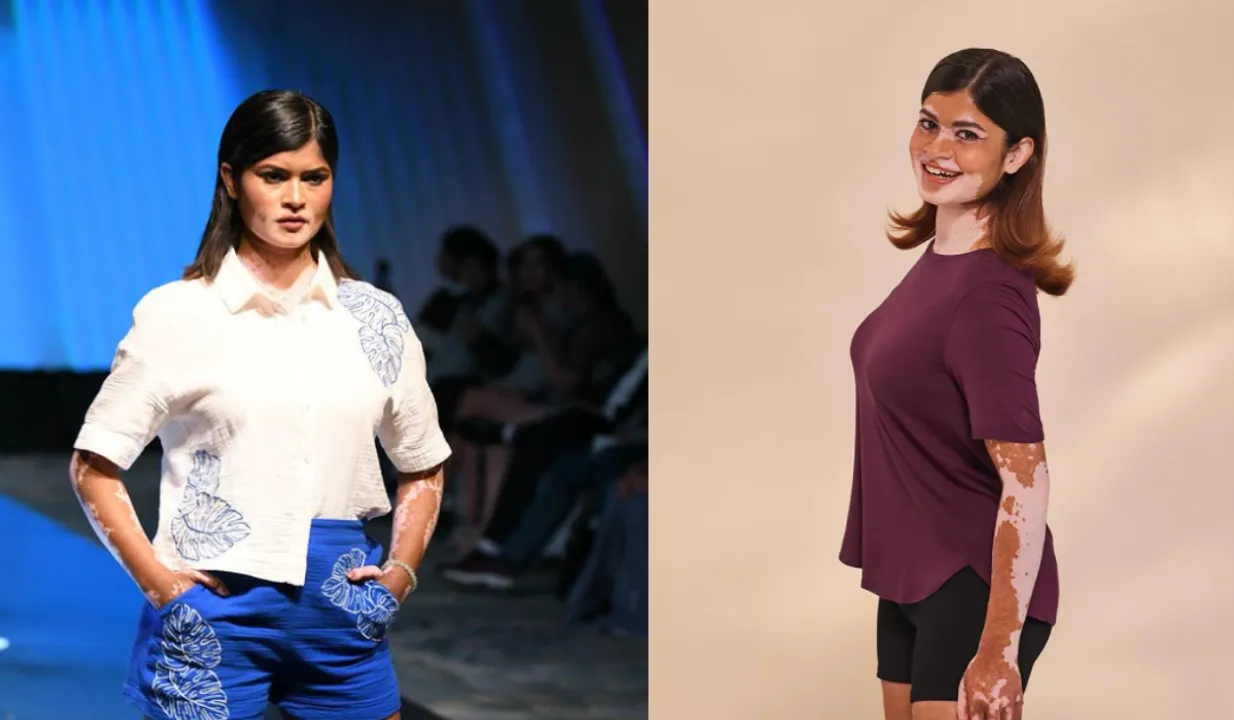 How Niha Sarkar Is Embracing Vitiligo To Redefine Beauty Standards