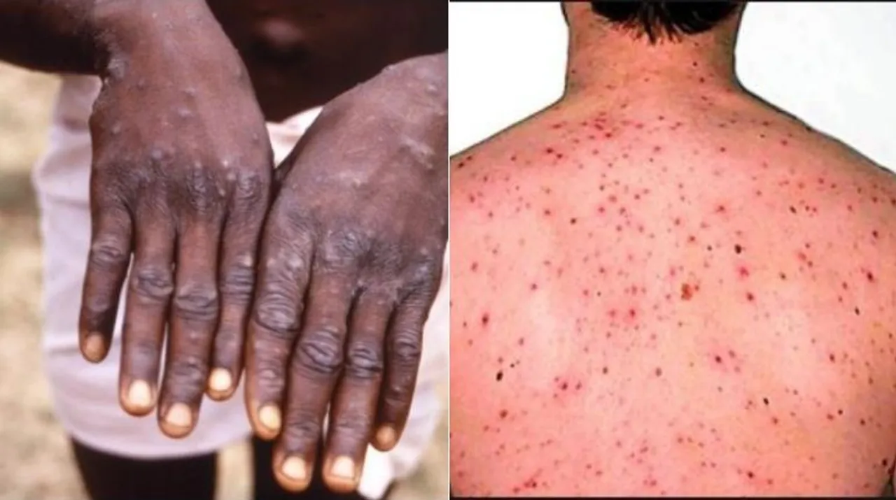  Monkeypox Photograph:(X) 