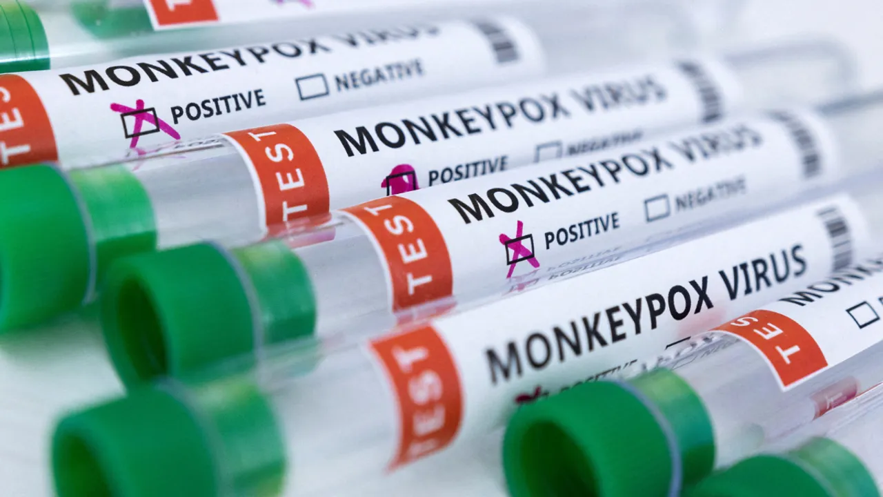  Monkeypox Photograph:(Reuters) 