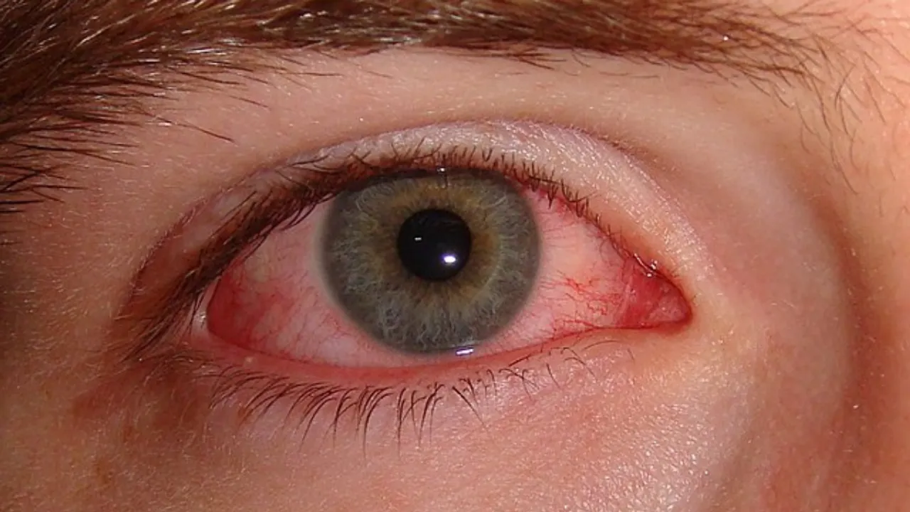  Conjunctivitis Photograph:(Others) 