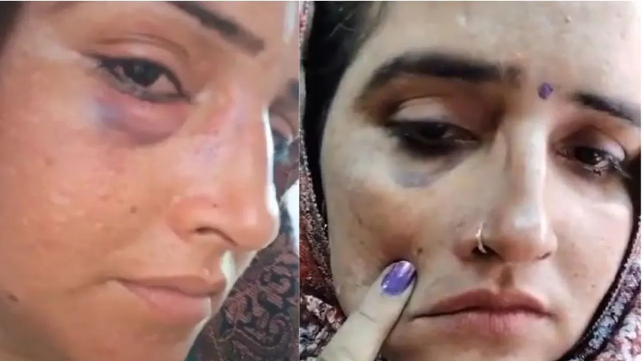  The video which shows Seema Haider with a swollen eye and a bruised lip was quick to spark rumours of domestic violence and physical violence by the husband Sachin Haider. Photograph:(X) 