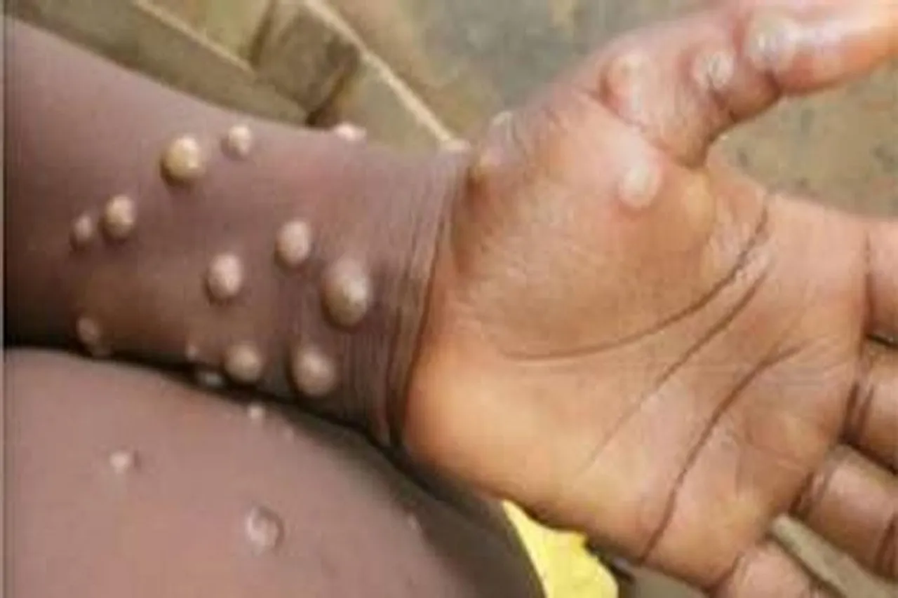 Central govt warns states over Monkey pox