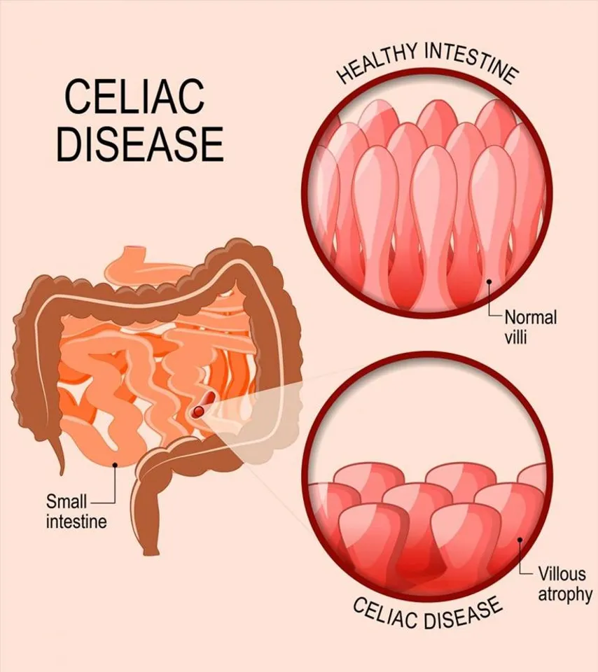 SIGNS AND SYMPTOMS OF CELIAC DISEASE