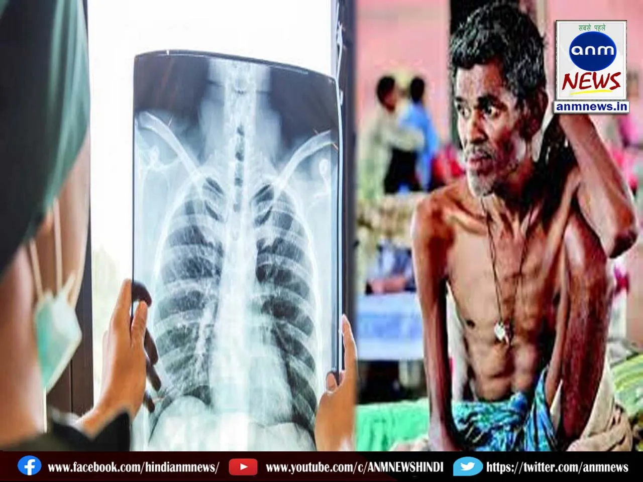 TB cases in India