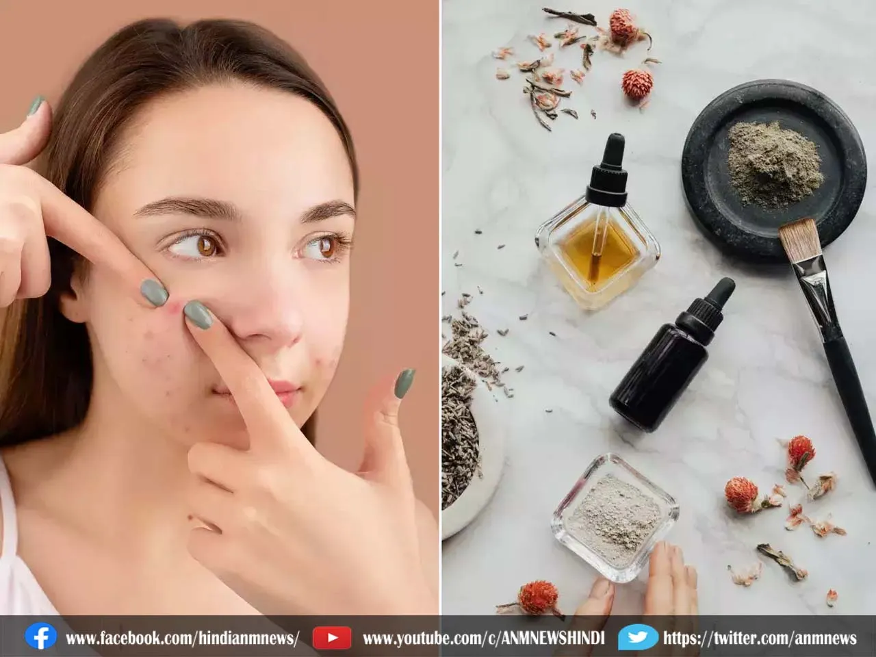 Acne Prone Skin के लिए बेस्ट घरेलू नुस्खे