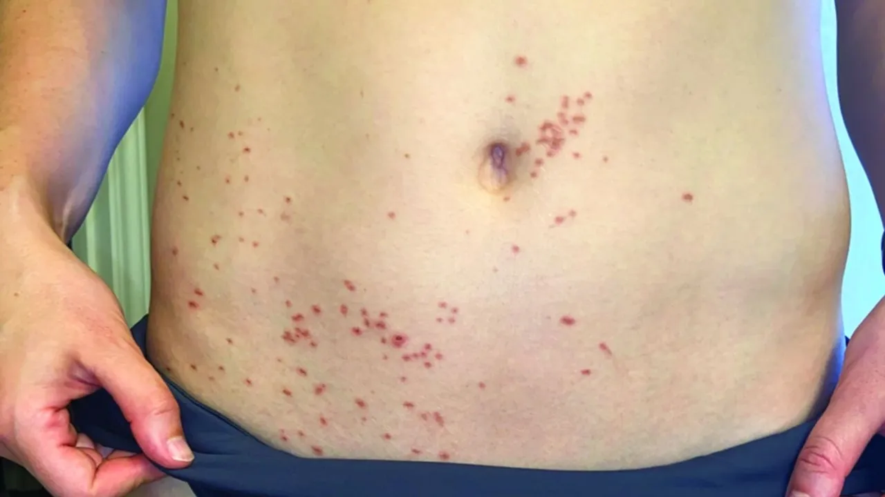 Sun Exposure After Handling Limes Linked to 'Margarita Rash