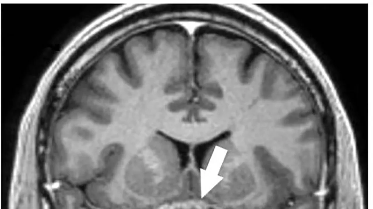 Sudden Blindness Post Fourth Pfizer COVID-19 Vaccine Dose Linked to Brain Tumor