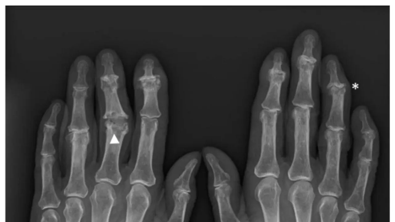 Rheumatoid Arthritis Drug Methotrexate Offers New Hope for Hand