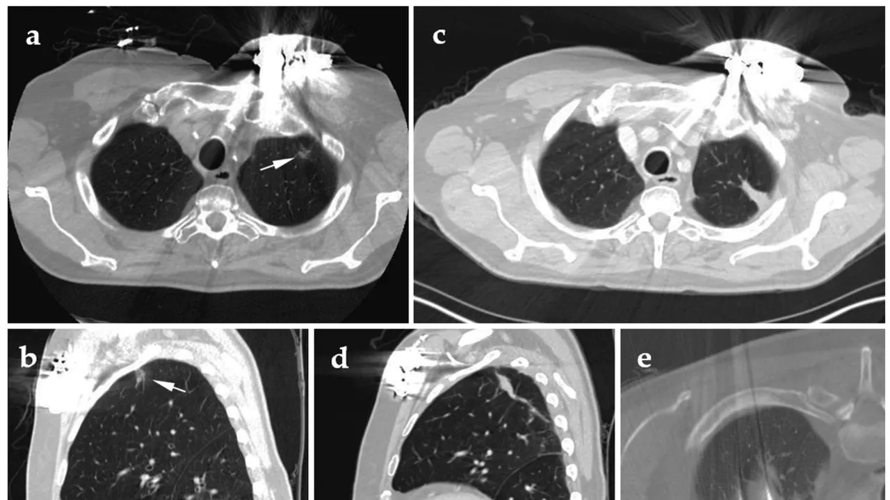 Groundbreaking Endoscopic Ablation of Lung Cancer Performed in Belgium