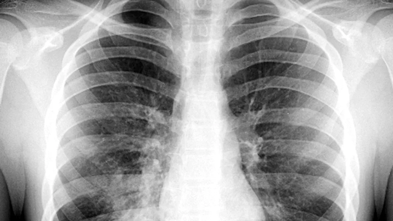 Rising Concern Over 'White Lung Syndrome' Linked to Pneumonia