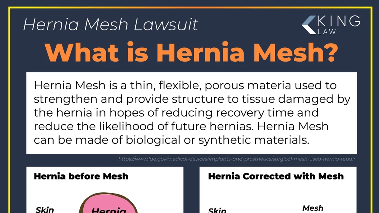 Bard Hernia Mesh Lawsuits Plaintiffs Demand Remand amid Stalled