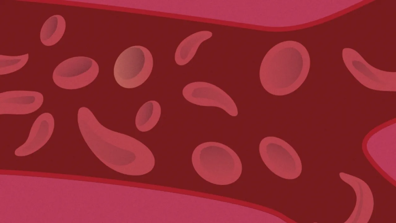 Study Highlights Sickle Cell Disease Prevalence in Socially Disadvantaged Areas