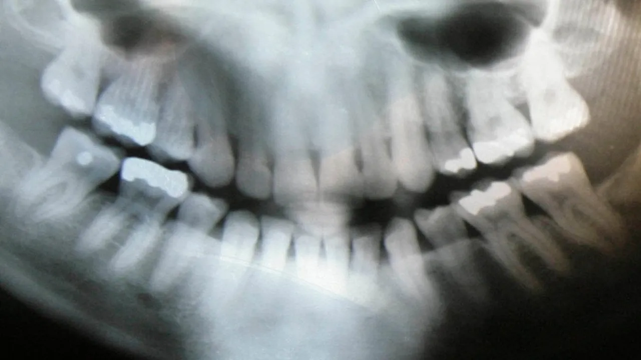 ADA Updates Guidelines Lead Aprons No Longer for Dental Xrays