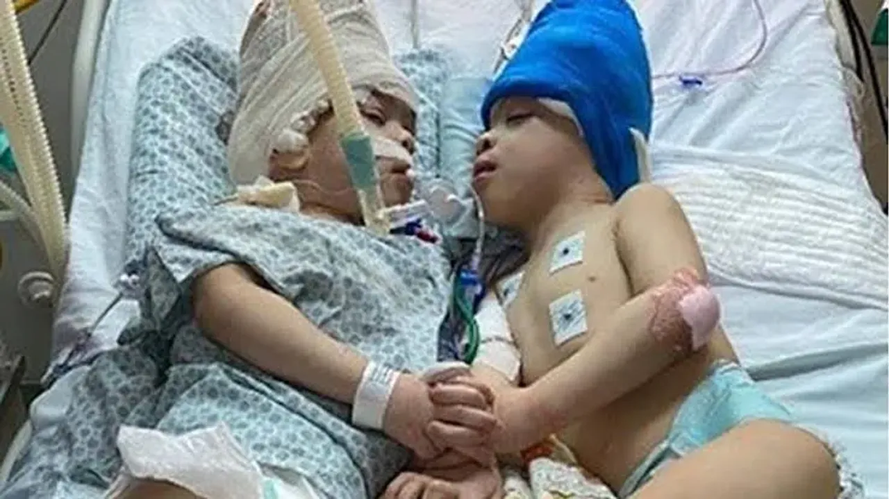 Conjoined twins separated with the help of virtual reality