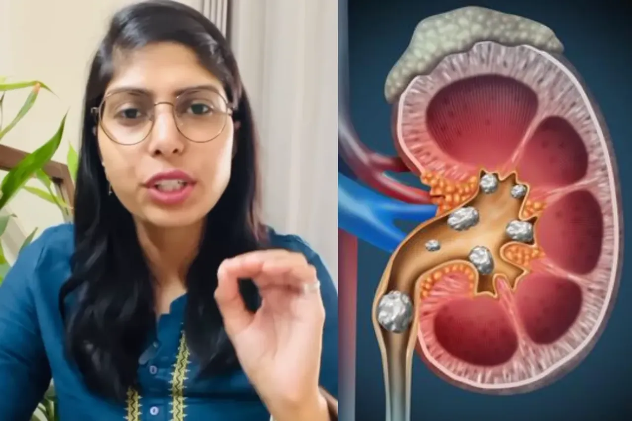 Kidney Stones