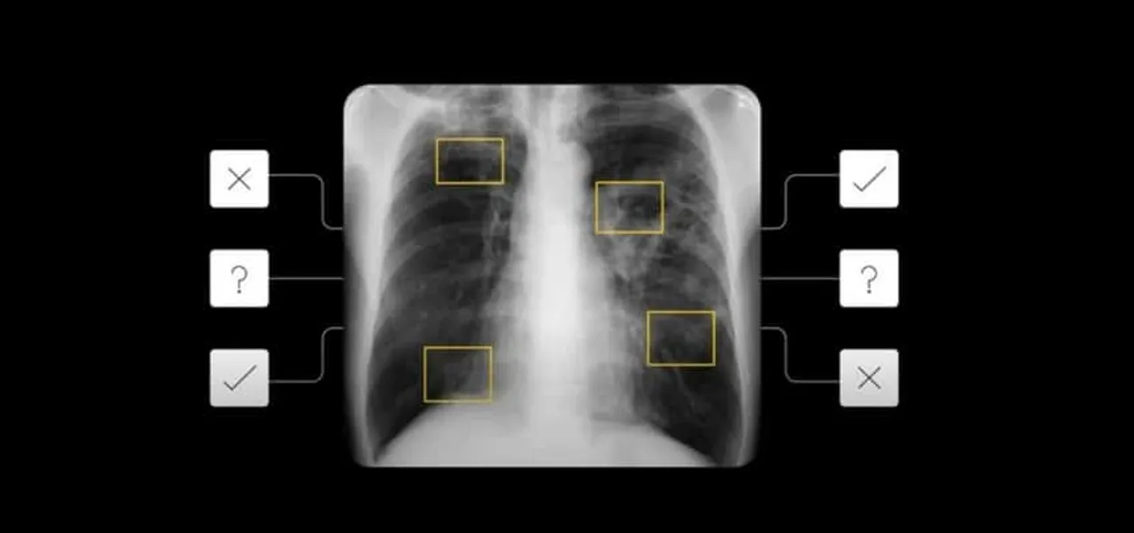 How AI aids in tackling tuberculosis