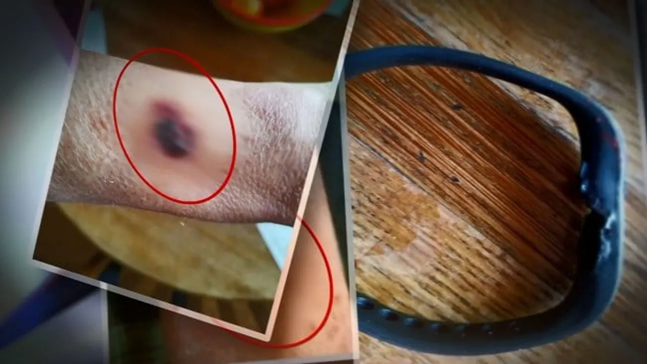 Fitbit Flex 2 burns woman’s arm