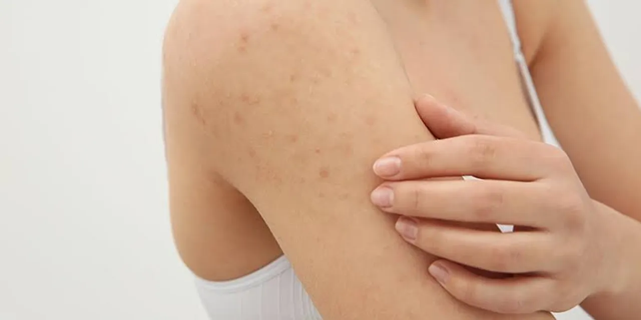Keratosis Pilaris incurable skin disease, Symptoms and cause
