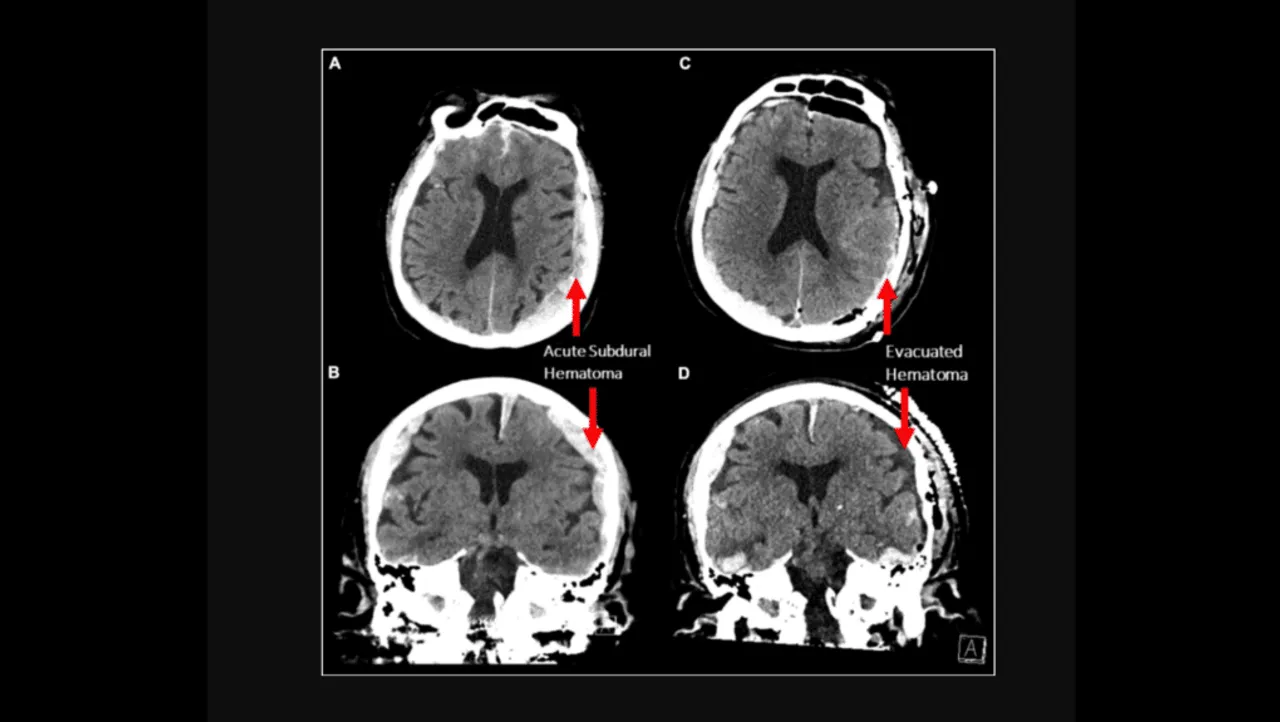 What happens in our Brain when we Die?