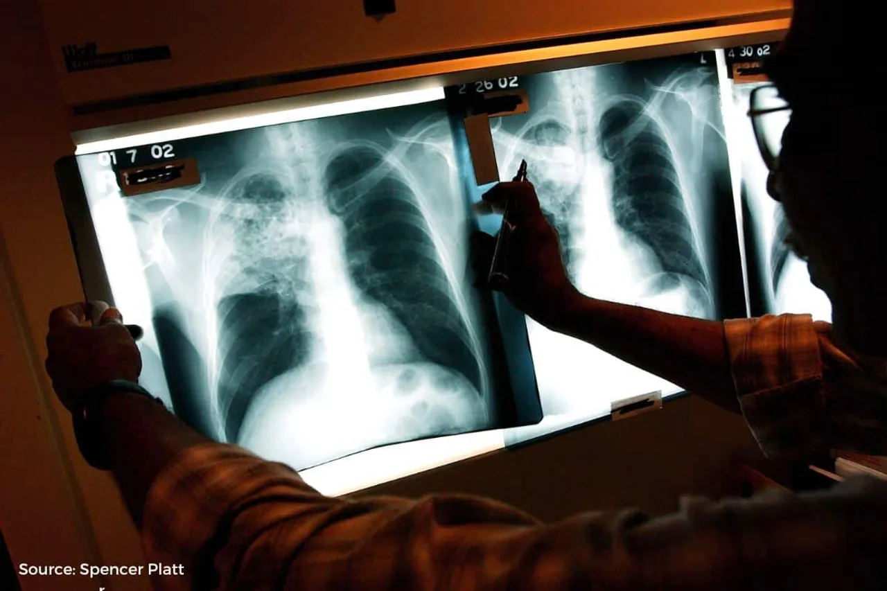TB cases on rise, jeopardized Mumbai's 2025 TB-free target