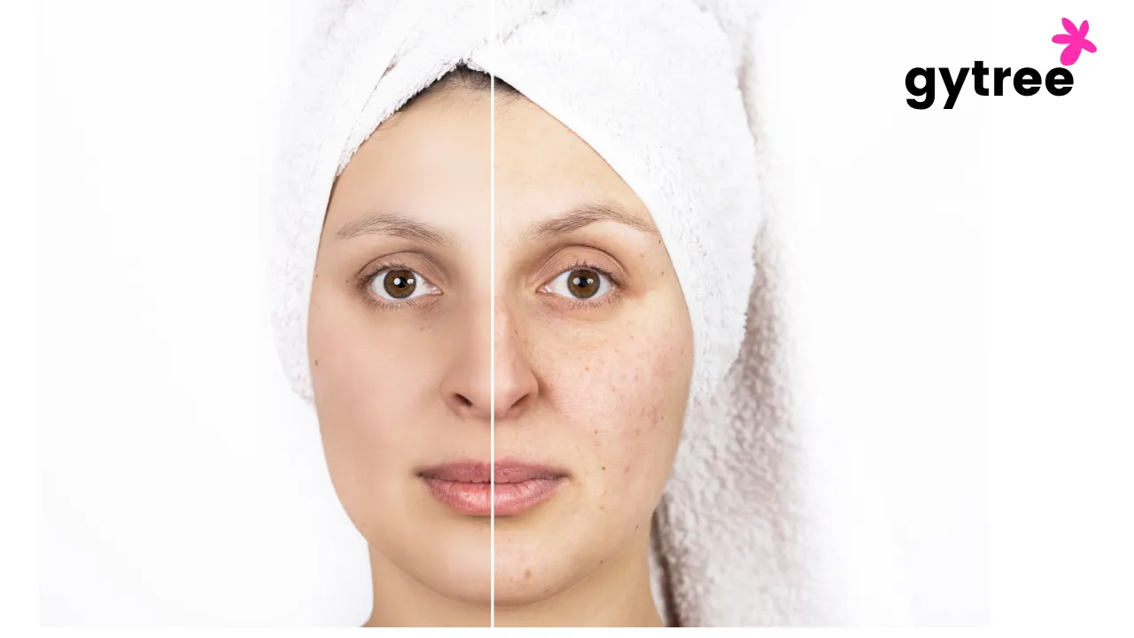Pollution & Skin- How is pollution wreaking havoc on your skin?