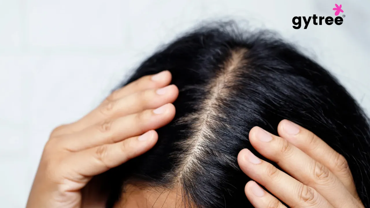 What is male and female pattern baldness?