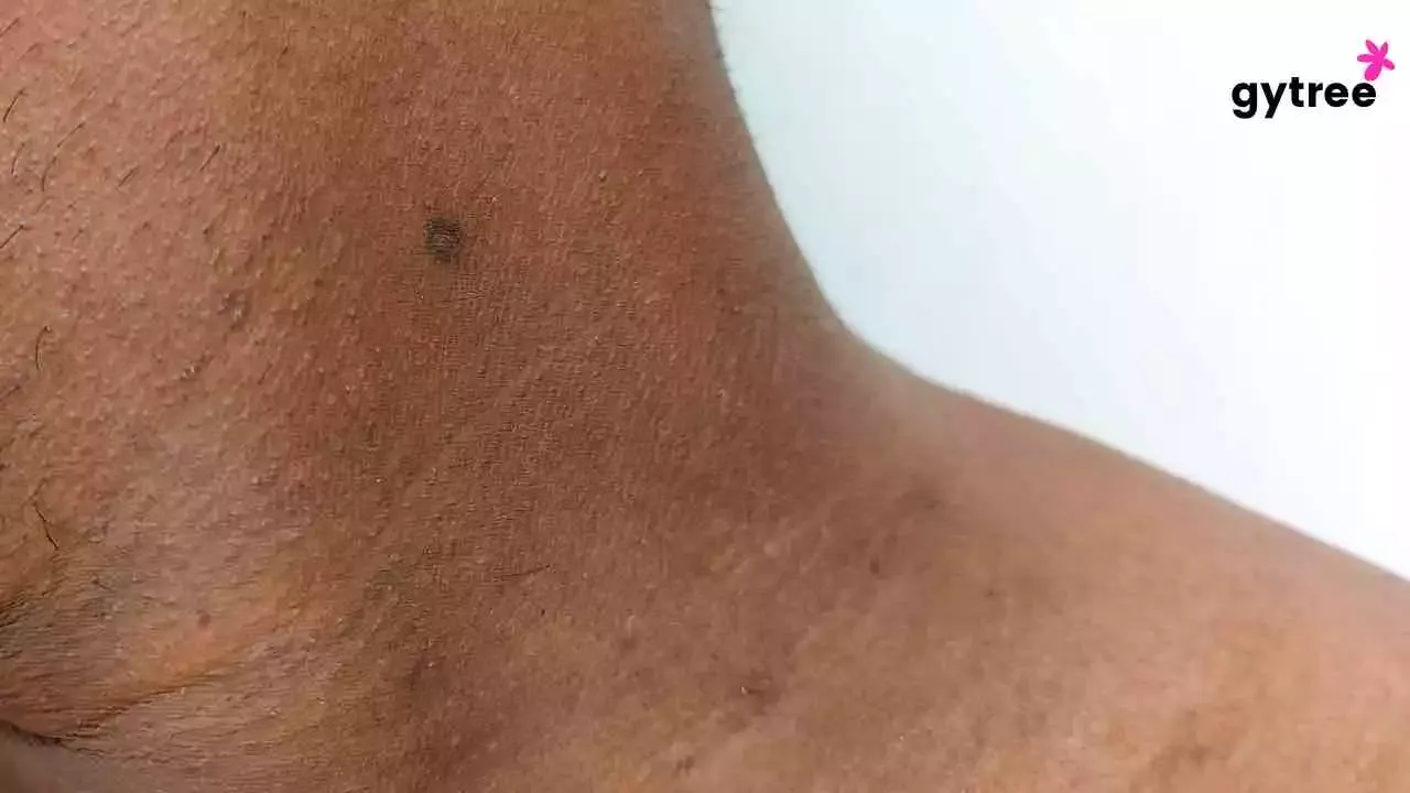 Black neck: Symptoms and treatment