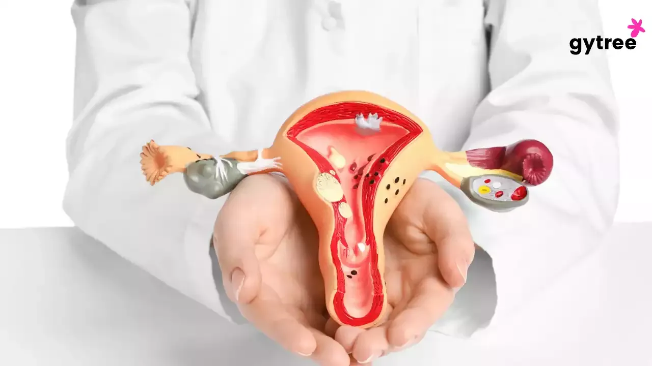 Vaginal bleeding between periods