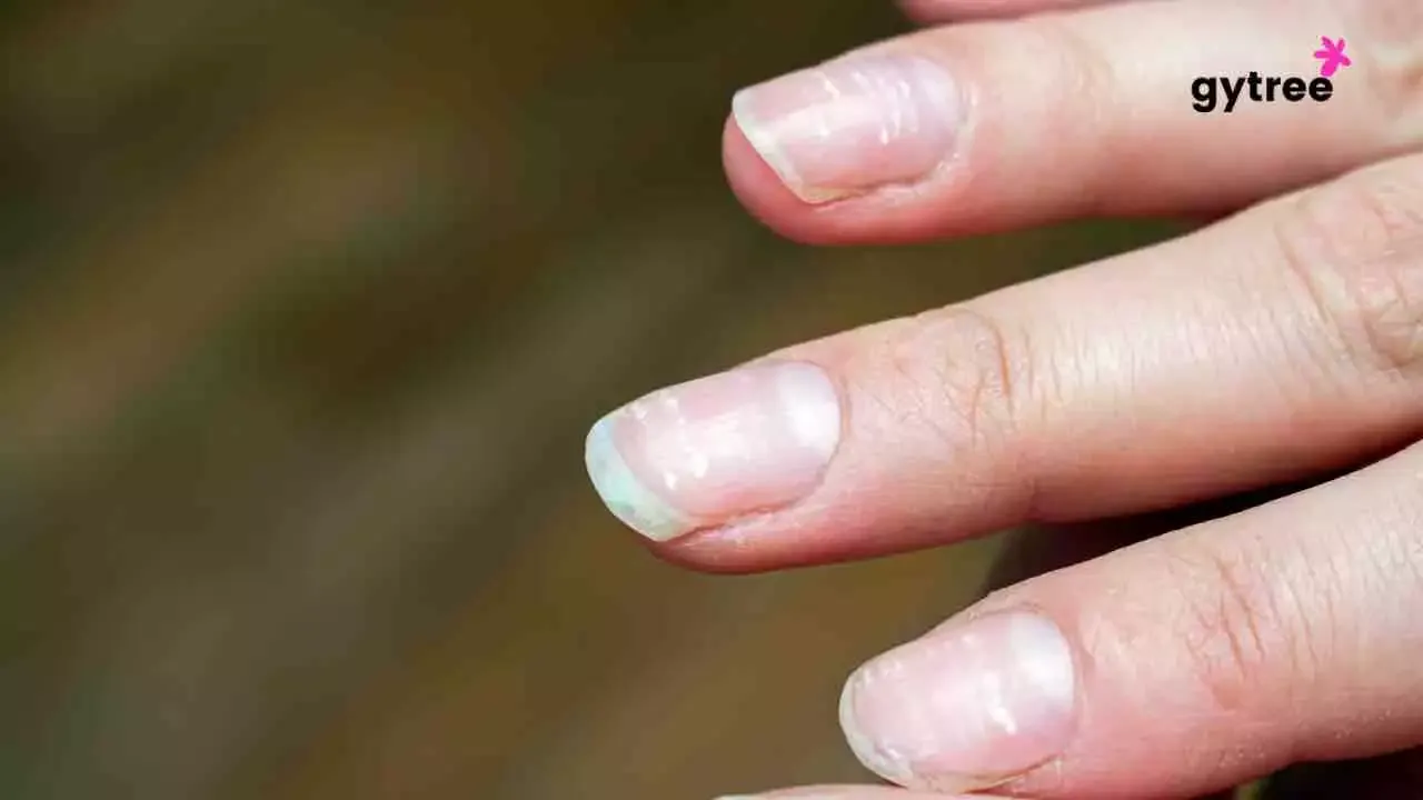 White spots on nails: 7 common causes