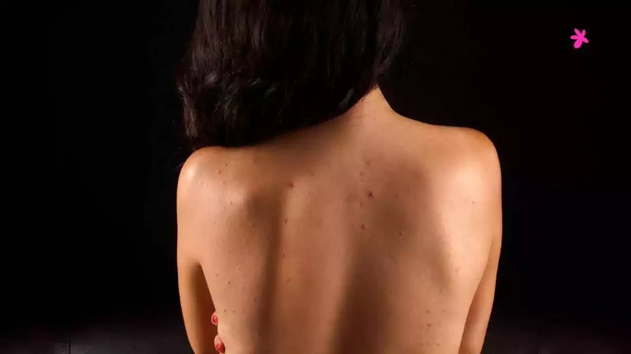 Back Acne: Symptoms & effective solutions.