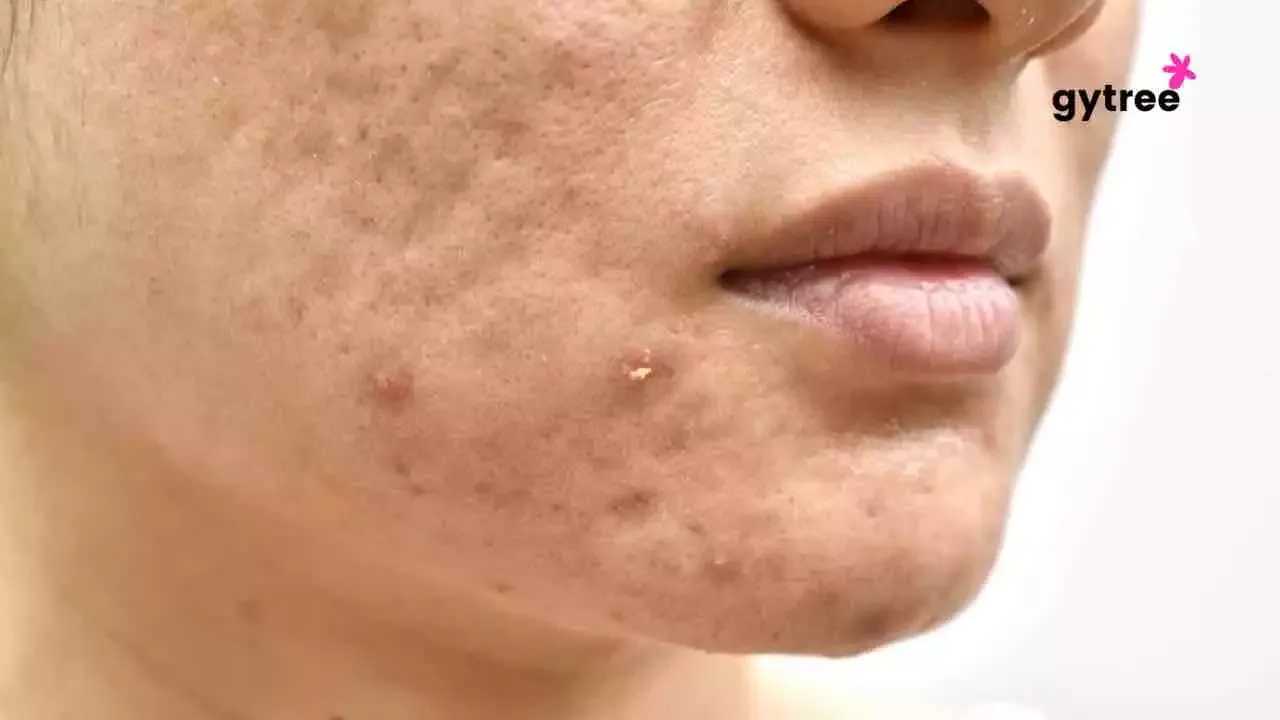 Acne during periods: What’s the solution?