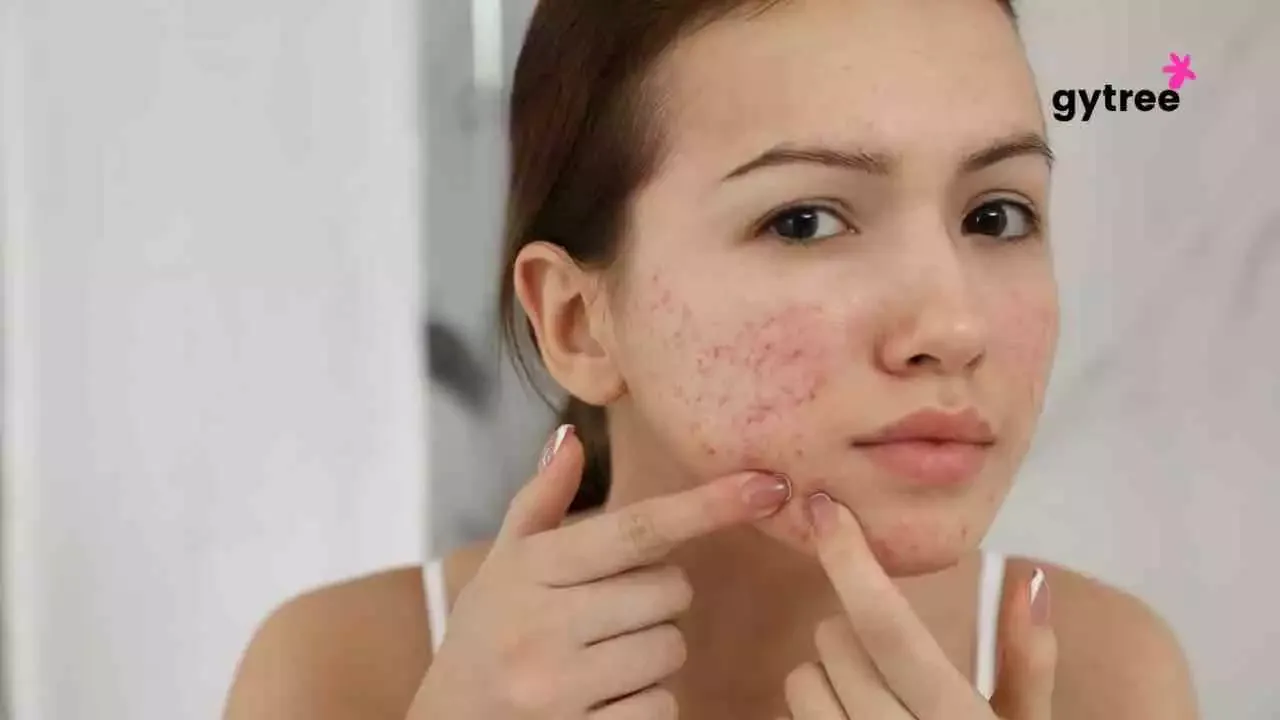 Hormonal acne in women: 7 Do’s and Don’ts
