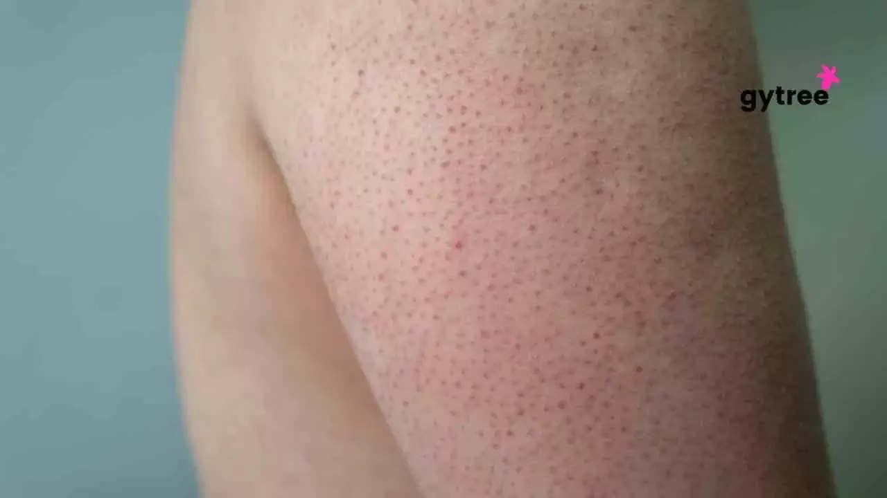 Say Goodbye to Keratosis Pilaris: 10 Ways