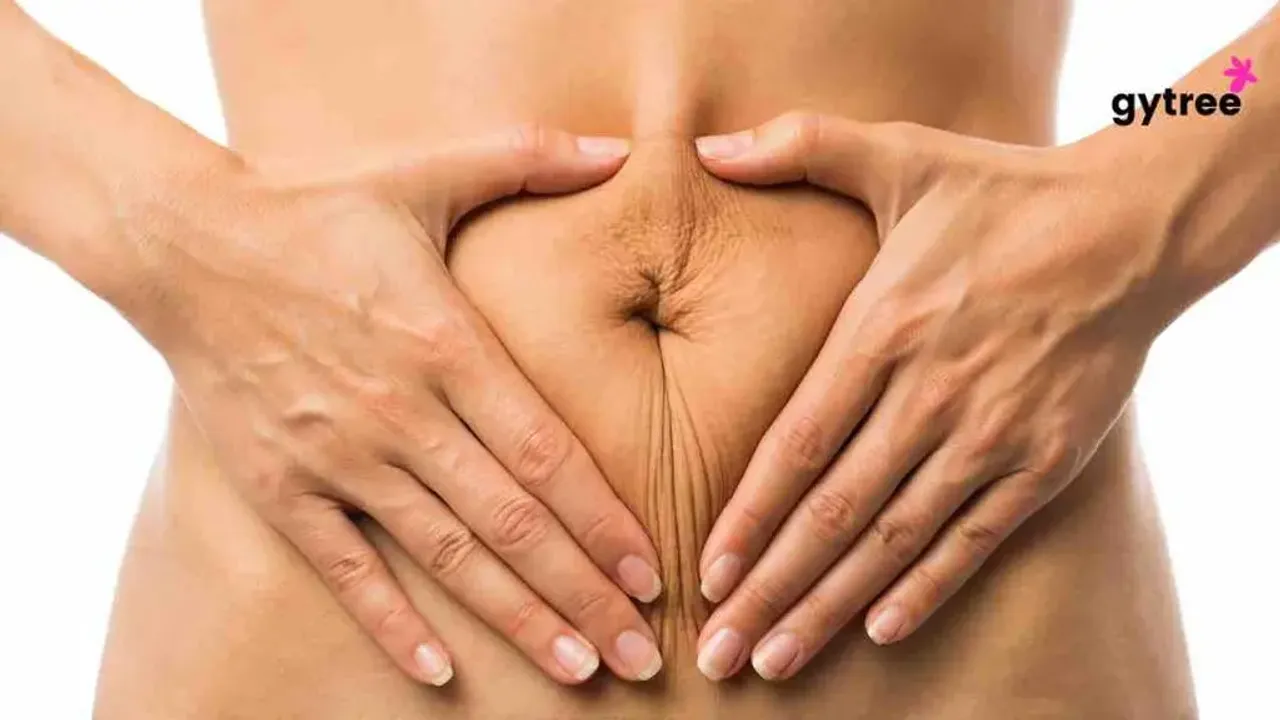 Embrace Your Stripes in 10 Ways: A Brief View at Stretch Marks in Women