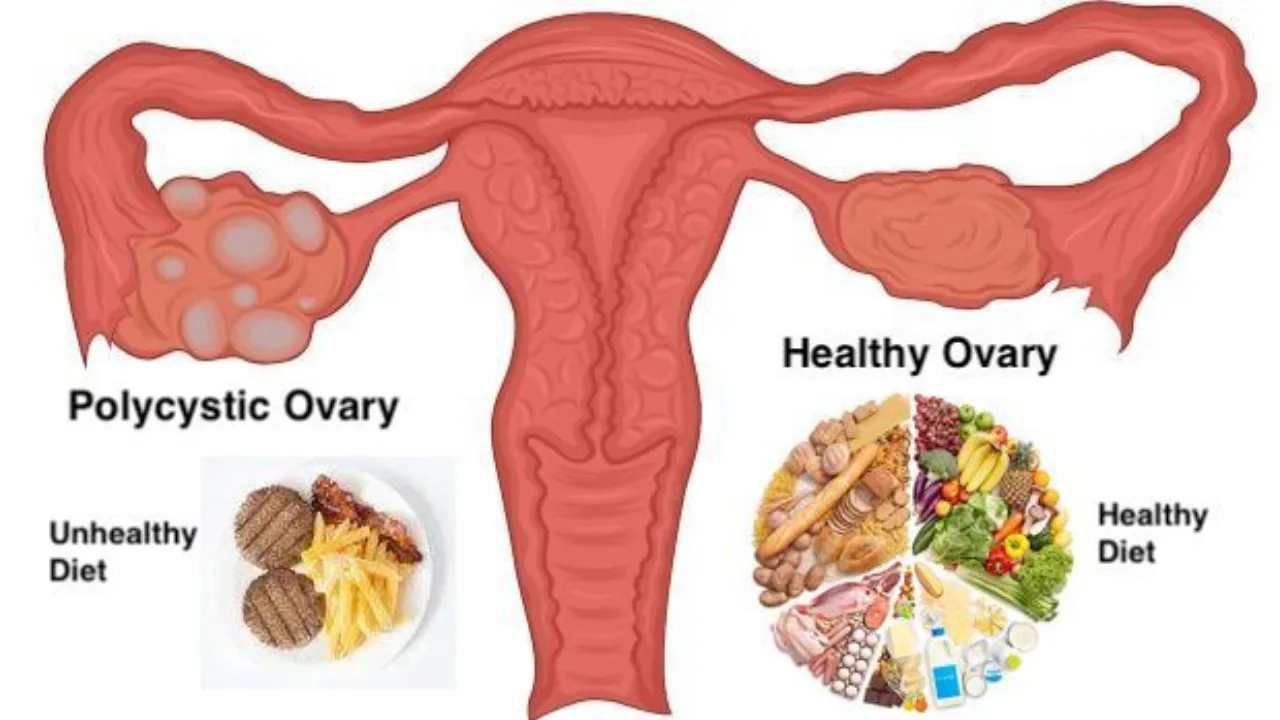 PCOS Problem (1)