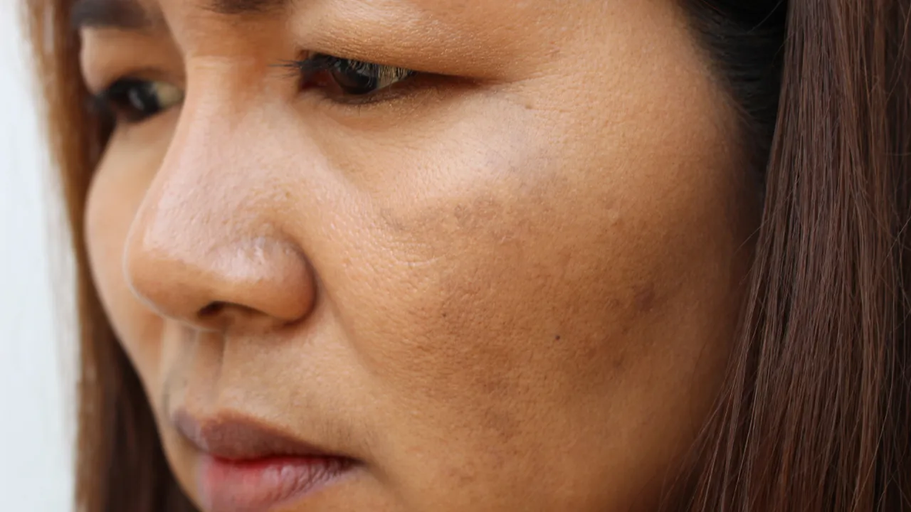 dull skin